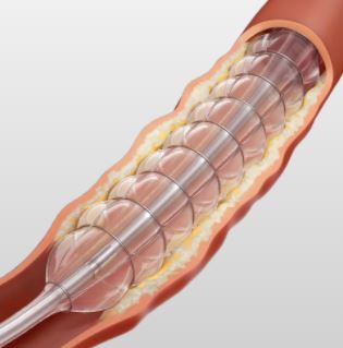 Perifeersete veresoonte sekkumise nitinooli balloon